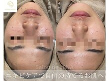 サロンドレナ 名駅店/ハーブピーリング サロンドレナ