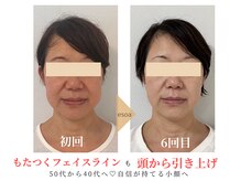 もたつきもたるみも同時改善♪頭からスッキリリフトアップ