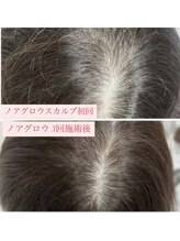 ニューユー(NewYou)/ノアグロウスカルプ