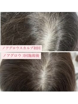 ニューユー(NewYou)/ノアグロウスカルプ