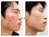 【本気の肌質改善】ニキビ・毛穴に◎韓国発、ハーブピーリング/那須塩原