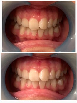 ベリール バイ ラスティ(Belile by LUSTY)/セルフホワイトニング