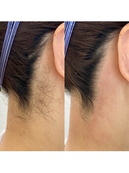 ヒスイ バイ アメイジング(Hisui by AMAZING)/【ワックス脱毛】うなじ