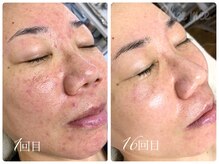 シェミー(CHEZ MEE)/【16回】自信が持てるお肌へ★