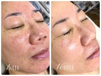 シェミー(CHEZ MEE)/【16回】自信が持てるお肌へ★