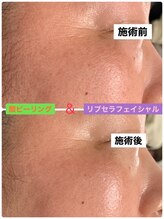 プリュネル(Prunelle)/酸ピーリング