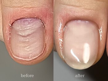 爪悩み専門店/凹凸改善