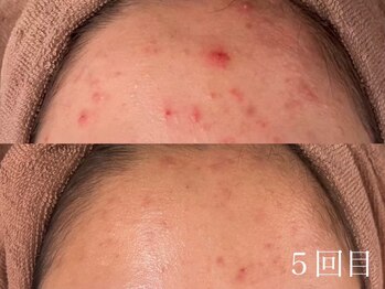 アワピール 天王寺店(AWA PEELL)/ハーブピーリング/ニキビケア