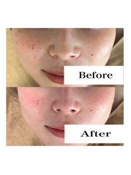 ライム 池袋東口(LIME)/Before&After　顔