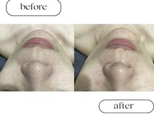 ルボン(RUBON)/毛穴