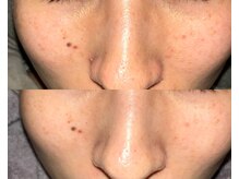 ル シーニュ/プロセルフェイシャル×2回