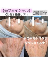 アースコアフュールボーテ ひたち野うしく店(EARTH coiffure beaute)/光フェイシャル★徹底しみケア