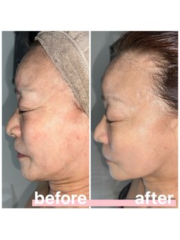 プリマ 大津店(PRIMA)/プラズマで肌トラブル解消！