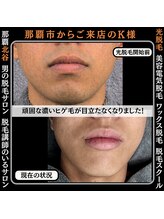 ディースタイル 北谷店(Dstyle)/那覇メンズ脱毛 Before After