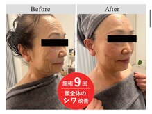 ボニータアンジュ 恵比寿(Bonita Ange)/恵比寿エクソ×ヒト幹細胞｜症例