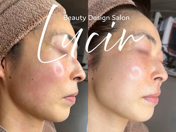 ルシール 仙台店(lucir)/<ララピール> Before/After