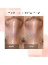 アーニストリィ(Earnestly)/ララピール　毛穴の開きケア