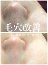リリアーナ(LILIANA)/ハーブピーリングで毛穴ケア
