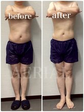 エアリアル 玉名店/脂肪冷却5回