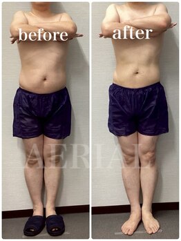 エアリアル 玉名店/脂肪冷却5回