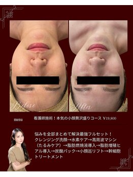 リノン(LIINON)/看護師施術×本気小顔フルコース