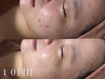 アワピール 天王寺店(AWA PEELL)/ハーブピーリング/ニキビケア