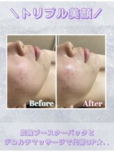 レイビス 盛岡店(RAYVIS)/トリプル美顔