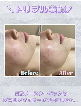 レイビス 盛岡店(RAYVIS)/トリプル美顔