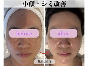 ミピマム 横浜駅前店/小顔・シミ改善BeforeAfter