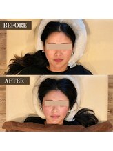 美整庵 谷山店(BISEIAN)/小顔矯正 before after