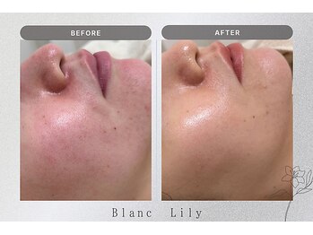 ブランリリー 福岡薬院店(Blanc Lily)の写真/韓国ブランドピーリング！ララピールでさらにお肌をワンランク上にしませんか！？