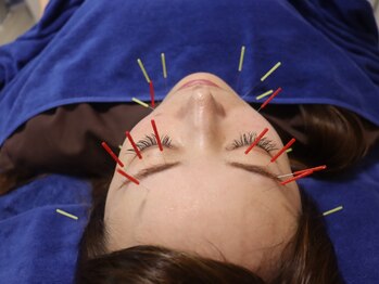鍼灸整体院アレンジ/ハリウッド式美容鍼(R)認定院