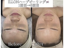 ラ ミュエル(La miel)/ILLONハーブ1回→5回