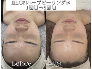 ラ ミュエル(La miel)/ILLONハーブ1回→5回