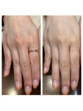 イーズ(ease)/ハンドトリートメントでの変化