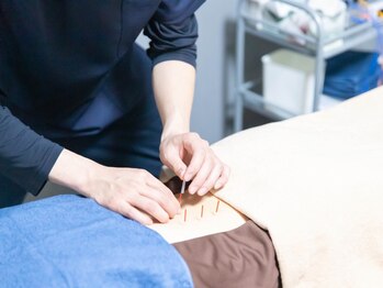 晴レノ日の写真/《鍼やお灸がはじめての方にもオススメ◎》痛みの少ないやさしい施術で肩こり・腰痛をしっかり改善！