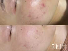 アワピール 天王寺店(AWA PEELL)/ハーブピーリング/ニキビケア