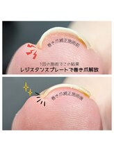 ミミカケルソラ(mimi×sora)/巻き爪補正★