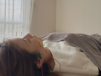 ユー(U.)の写真/眼精疲労でお悩みの方へ!美容鍼で速攻性◎の爽快感を体験しませんか?