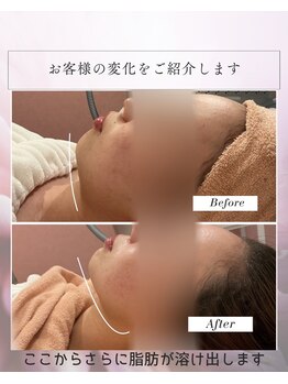 キャンディ 海老名駅前店(Candy)の写真/【大人女性のたるみケア】本気で始める予防美容！海老名初のマイクロ波リフトでキリッと引き締まった印象へ