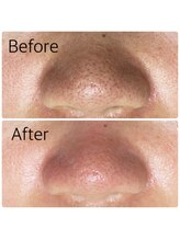 エステ シンセリティー(aesthetic sincerity)/毛穴洗浄9800円→モニター4500円