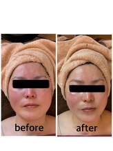 シュガー(Sugar...iyr)/陶肌トリートメント