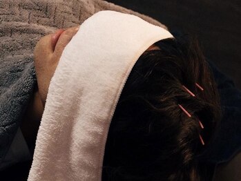 セント 江坂店(SCENT)/・・・頭皮鍼・・・