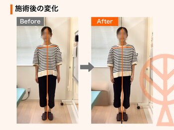 ただき接骨院 整体院 高関院/施術後の変化：肩こり・歪み