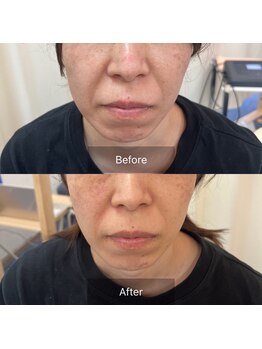 アズール(Azul)/小顔矯正(1回目)