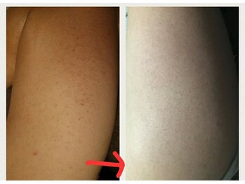 ベビースキン(baby skin)/二の腕のブツブツ改善