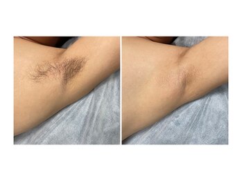 グリーンシャムロック(Green Shamrock)/脇脱毛