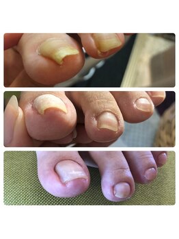 ディアドール(Dear doll)/巻き爪