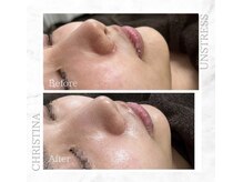 シャルムパリス(charme paris)/うる艶肌へ☆１回の施術変化