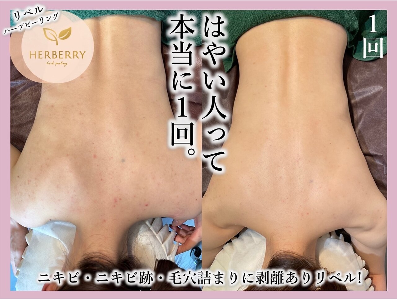 ハーブピーリング 剥離あり 業務用 オーガニック 漢方 和漢